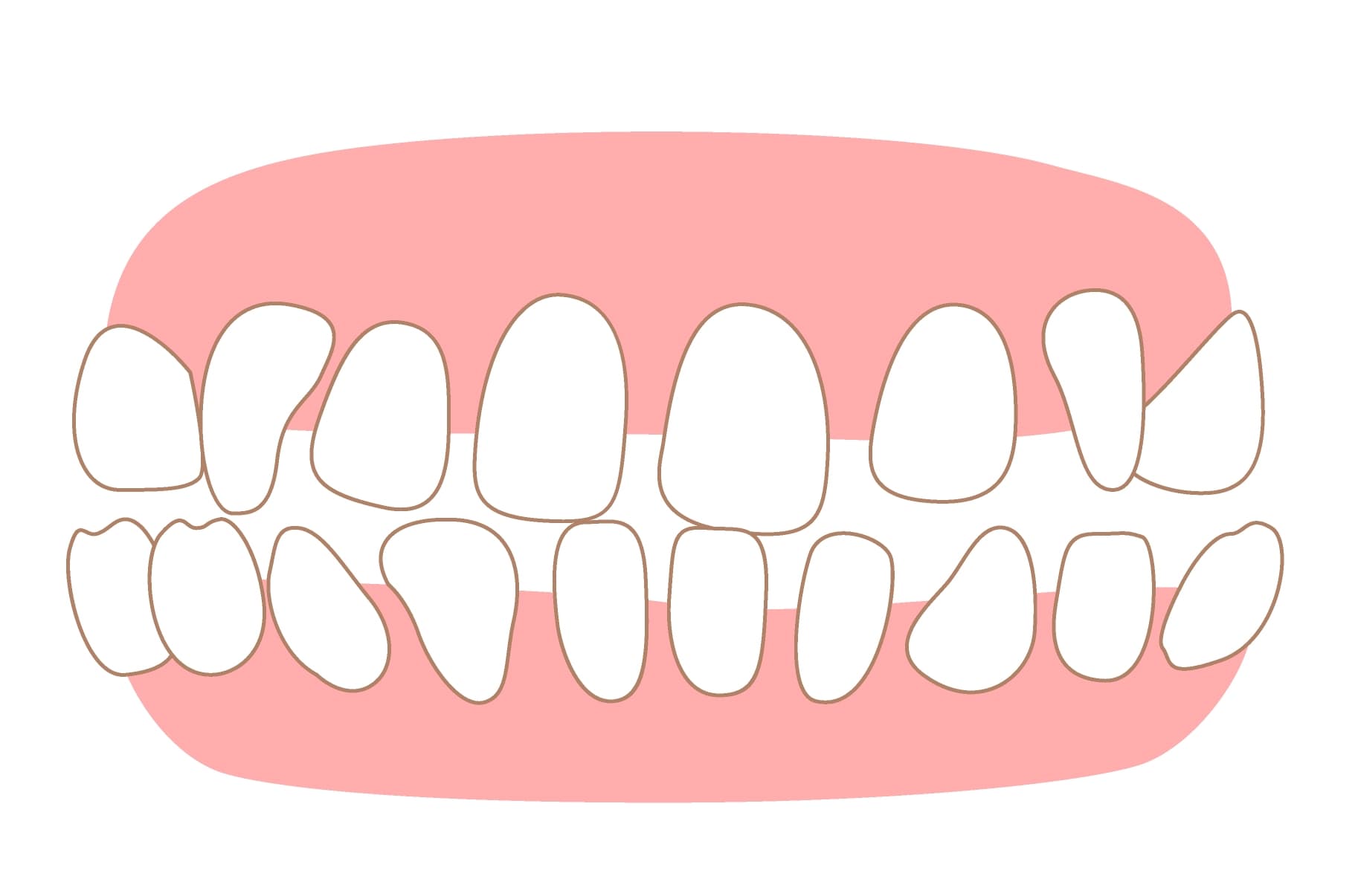 Spacing - Dental Condition