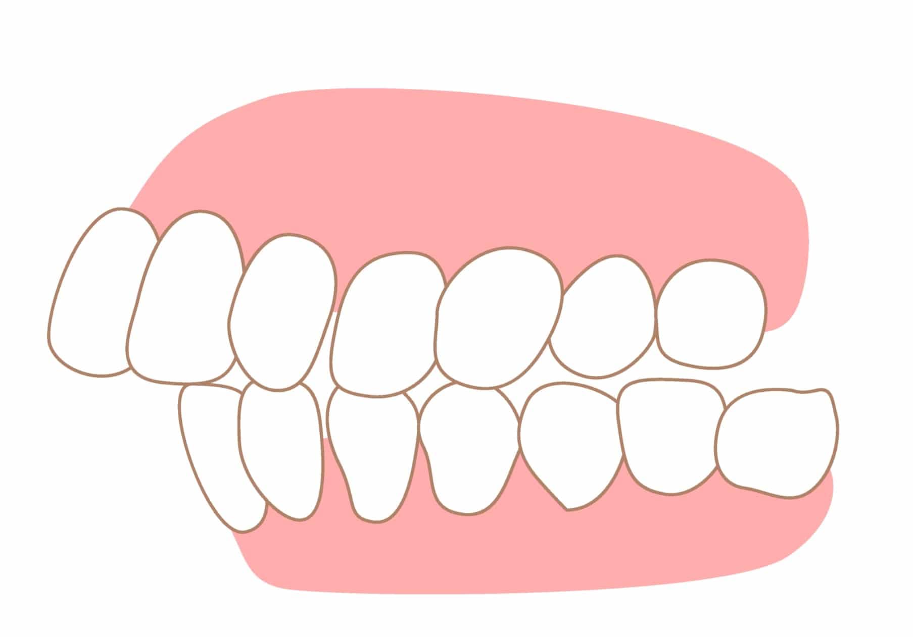 Overjet - Dental Condition