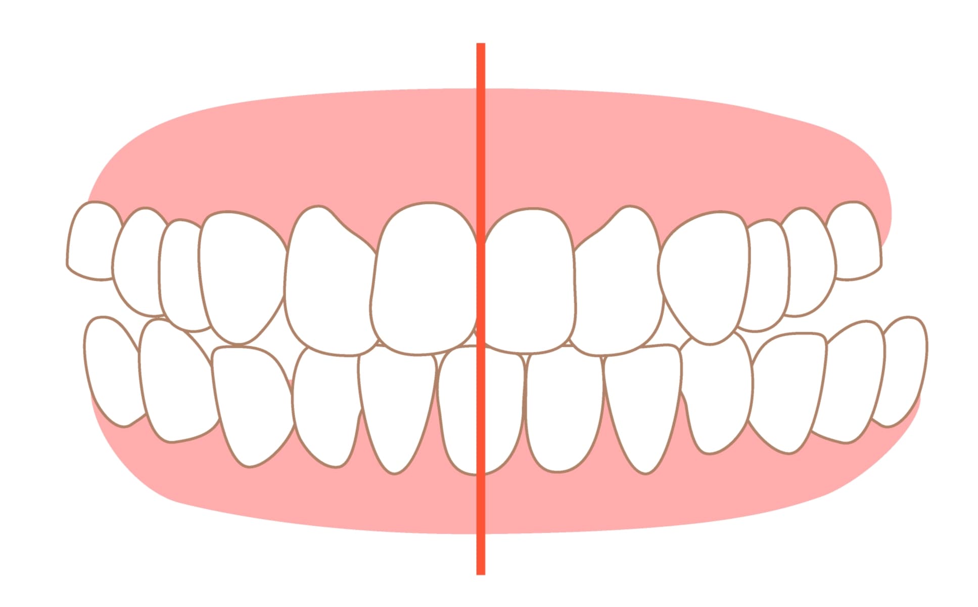 Crossbite - Dental Condition