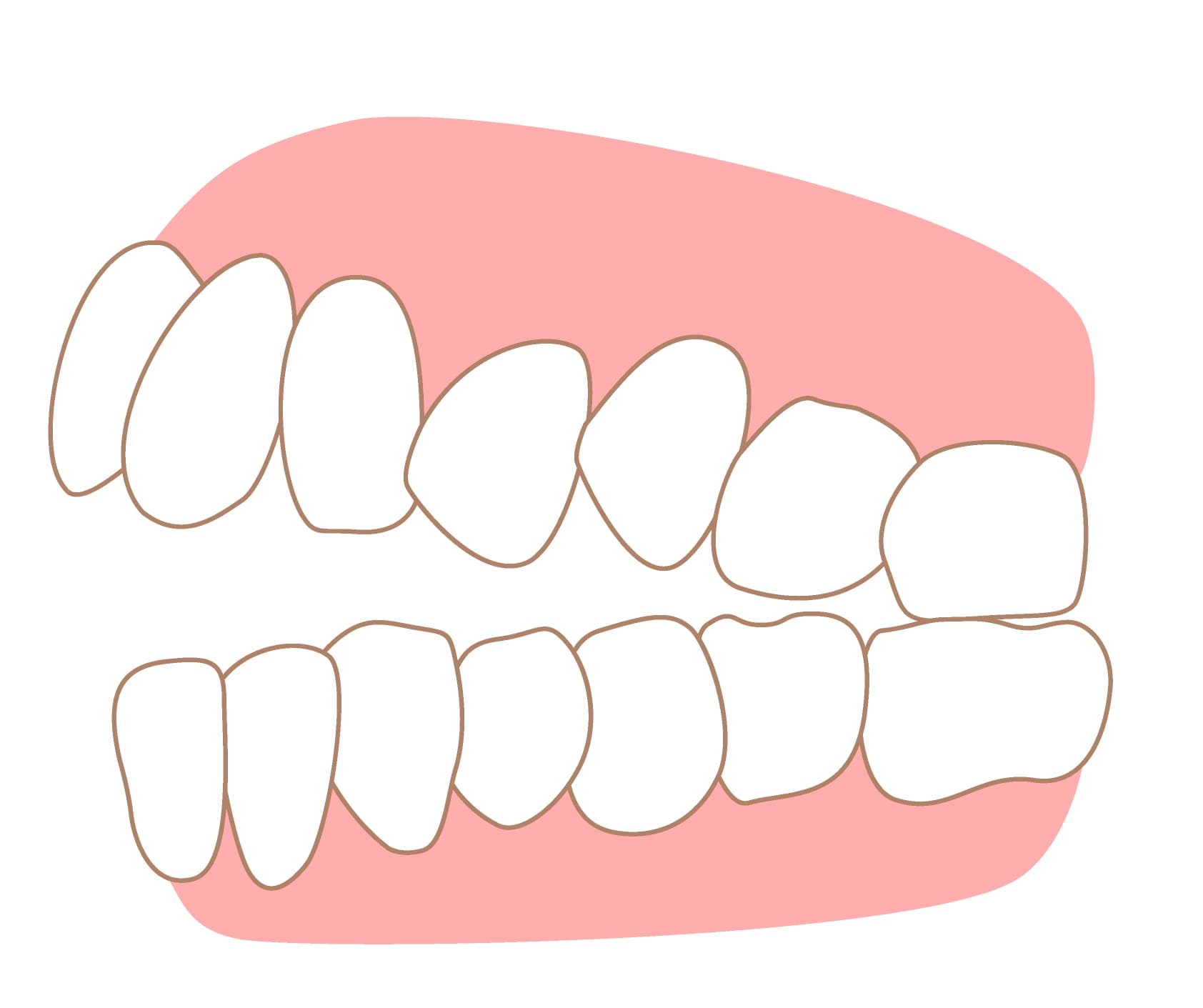Open Bite - Dental Condition