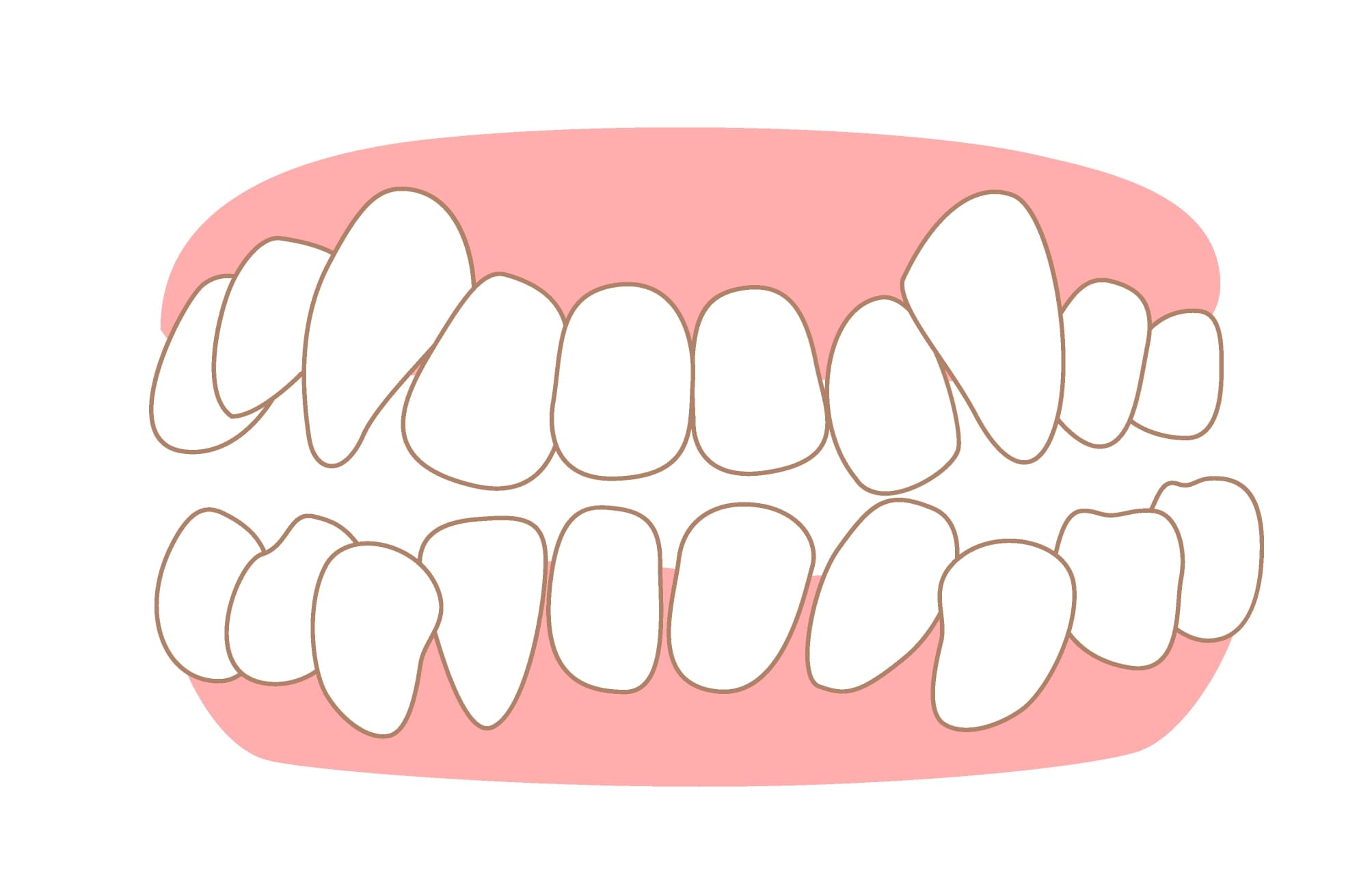 Crowding - Dental Condition