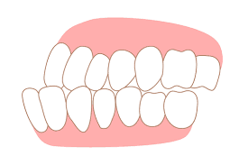 Underbite - Dental Condition