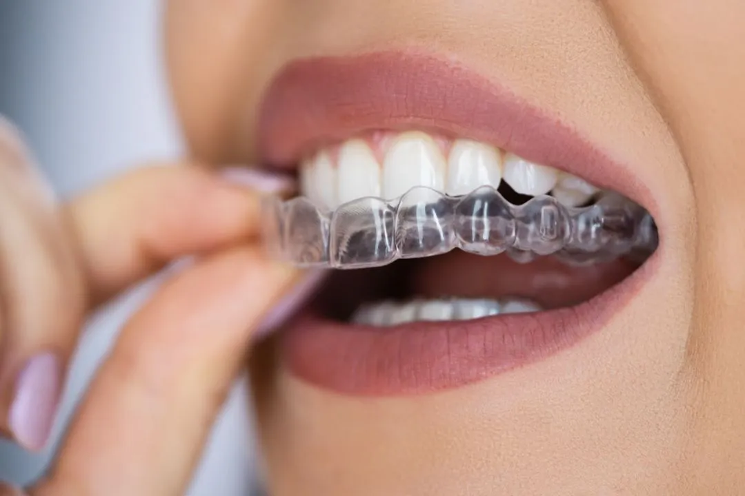 Beautiful Smile with Aligners